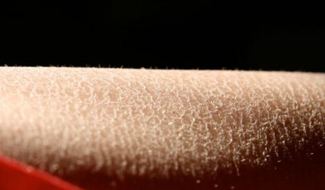 الصحة والحياة: جفاف الجلد وتشققاته