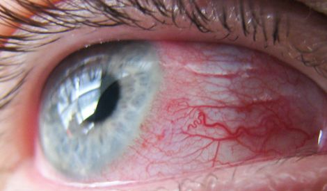 صحة وحياة: التهاب القرنيّة