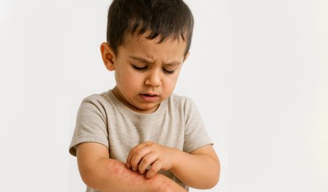 الأكزيما: الأسباب والعلاج